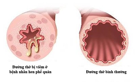 đường thở bị viêm